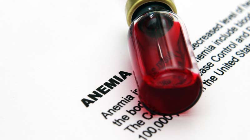 Anemia Iron Deficiancy