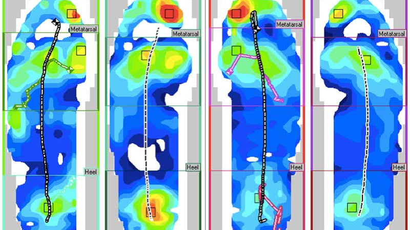 EMG Pressure Mapping